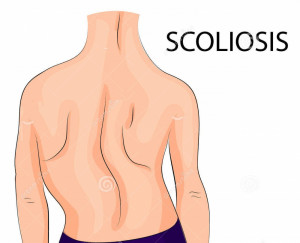back-scoliosis-fourth-degree-illustration-child-degrees-68557959