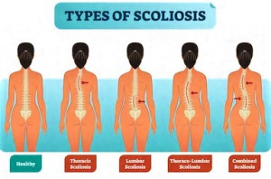 scoliosis